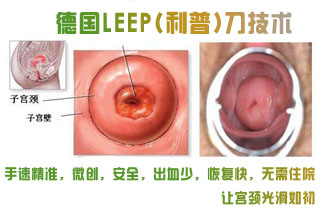 奥洛克利普术只除糜烂不伤宫颈
